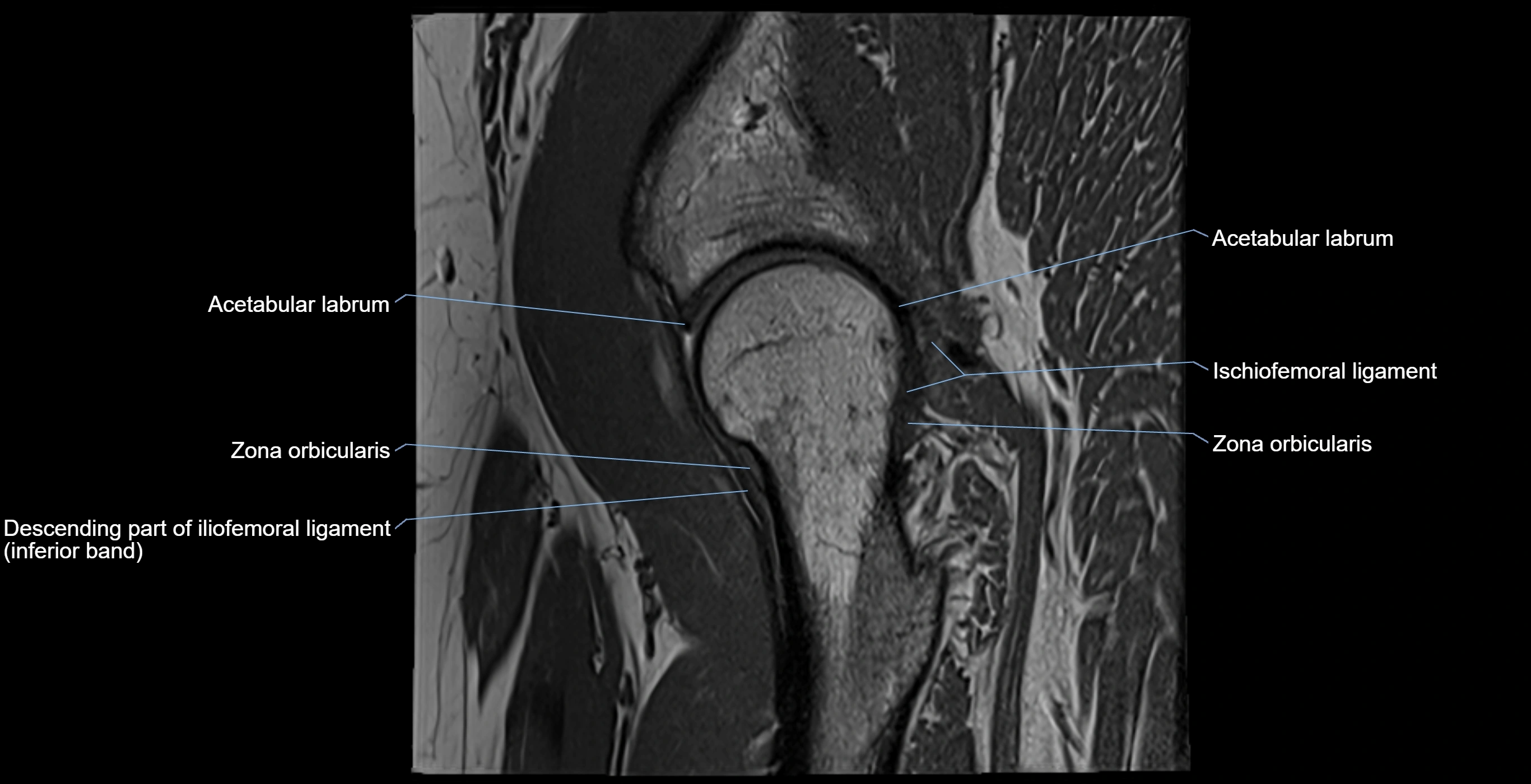 MRI Hip ligaments sagittal cross sectional anatomy 3T  radiology  image-img-00001-00012.webp